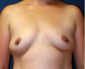 Feel Beautiful - Breast Augmentation 137 - Before Photo